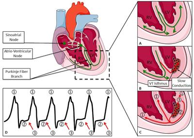 Stereotactic Radiotherapy for the Management of Refractory Ventricular Tachycardia: Promise and Future Directions